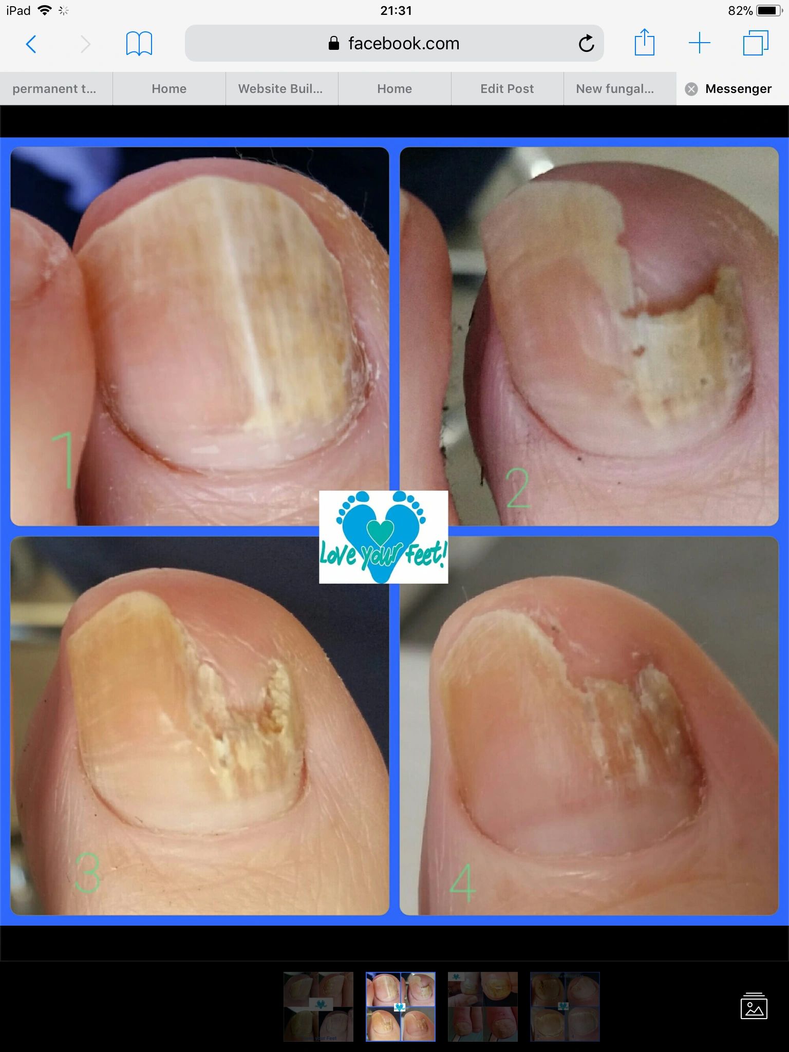 Lacuna Fungal Nail Treatment
