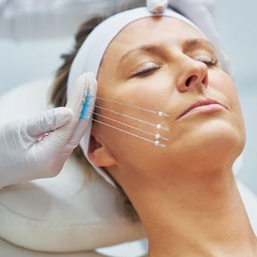 Woman undergoing a PDO threads lift treatment