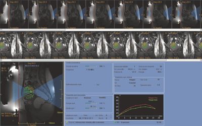 Esempio di pianificazione di una procedura di ablazione di un fibroma uterino.