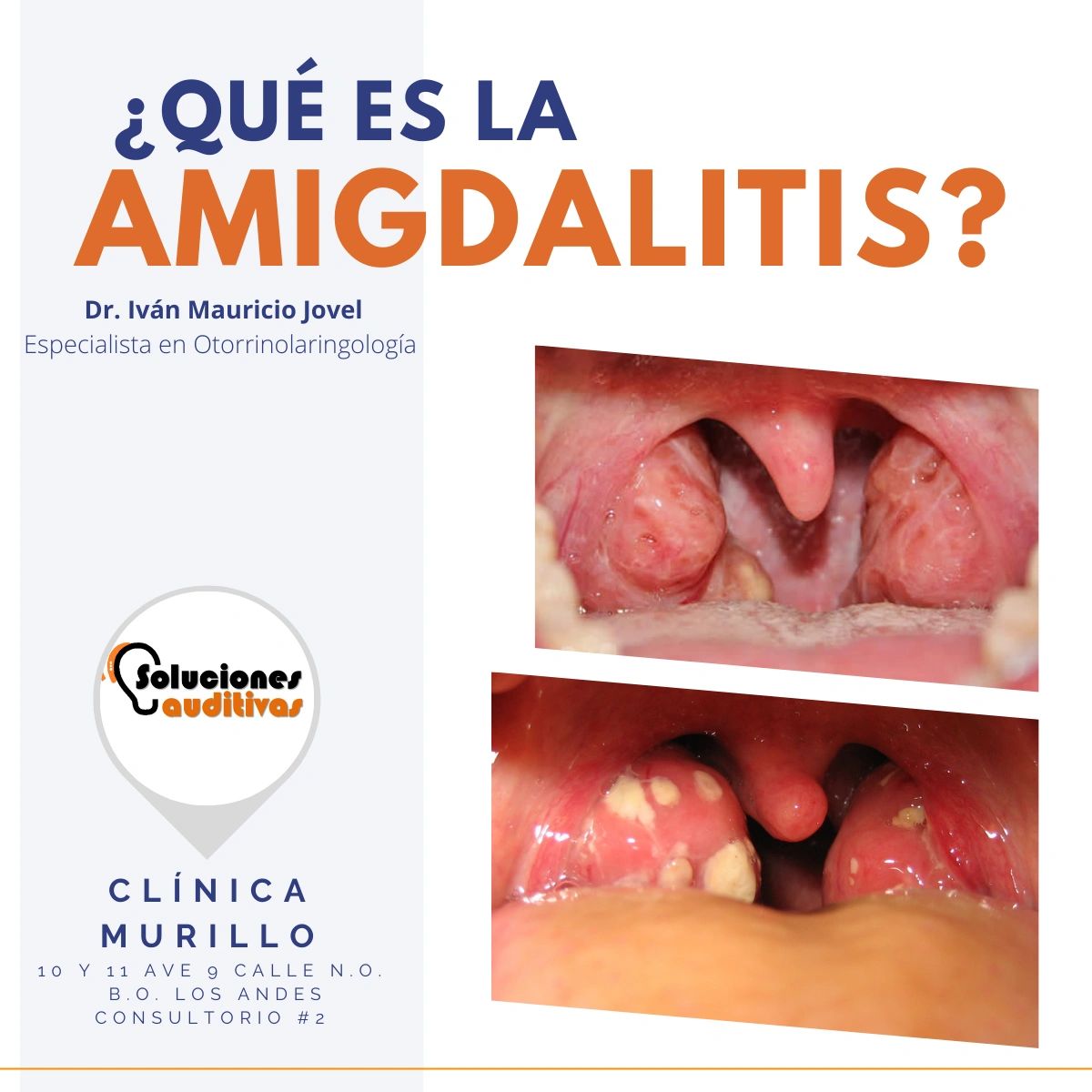 ¿QUÉ ES LA AMIGDALITIS?