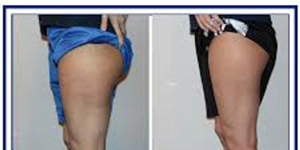 CryoSkin Body Toning, Lose Cellulite, Tone Legs and Thighs