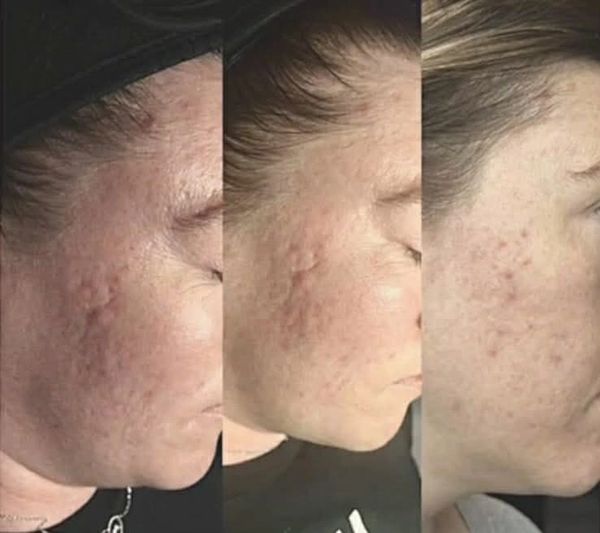 Three-stage progression of acne scar healing on a cheek.