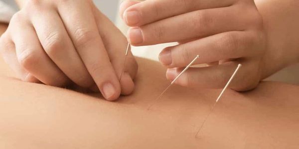 Dry Needling, Acupuncture, osteopath, physiotherapy, Chiropractor, pain, health, spine, back, neck