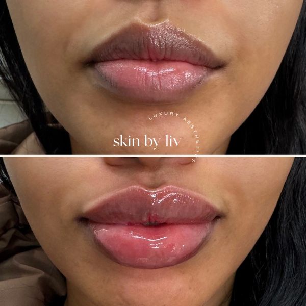 Lip filler before and after, woodbury med spa 