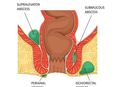 Vector illustration of an anal abscess.
