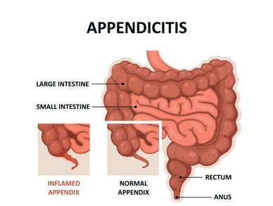Appendicitis is inflammation of the appendix. Digram of bowel with he appendix. 