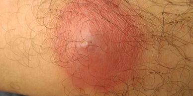 Boil or Furuncle on the leg. A painful, pus-filled bump under the skin caused by infected, inflamed 