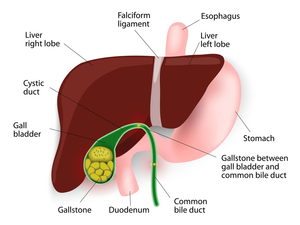 Gallstones develop because cholesterol and pigments in bile sometimes form hard particles. Cholester