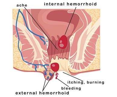 Vector illustration with haemorrhoids. 