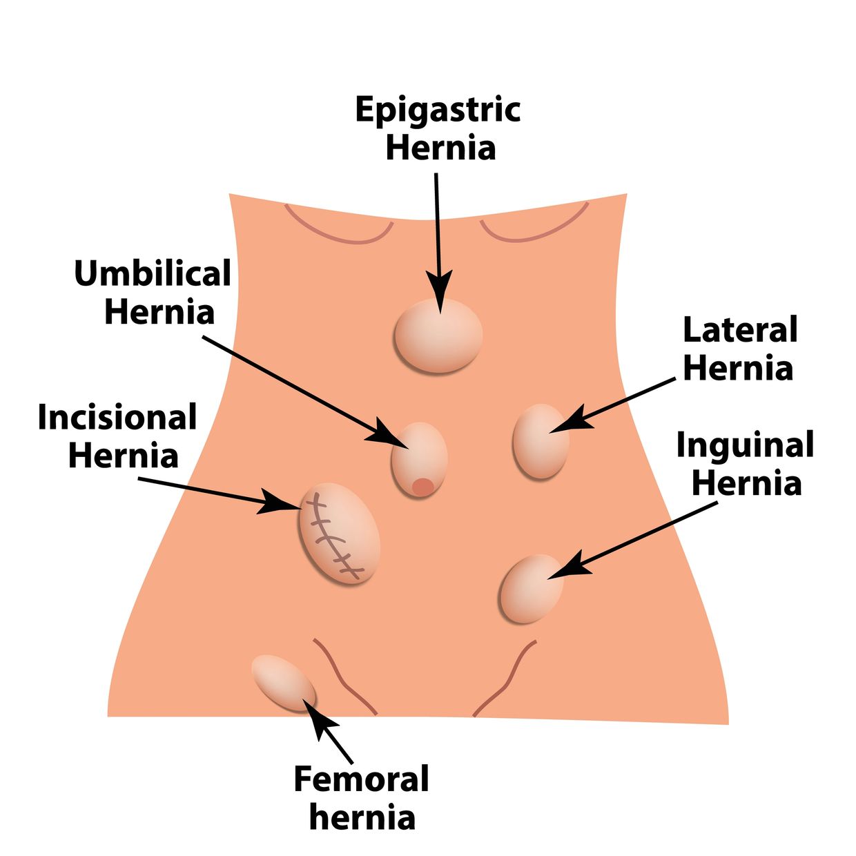 Types of hernia. a, Lateral, Umbilical, Inguinal, femoral, incisional hernia. intestinal hernia.