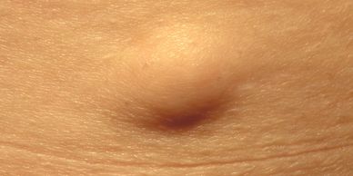Image of a lipoma on the skin