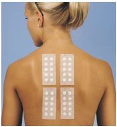 Patch Testing Dermatology Nhs _ PATCH TESTING: A BEST PRACTICE GUIDE ...