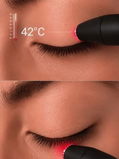 radio frecuencia para ojo seco
