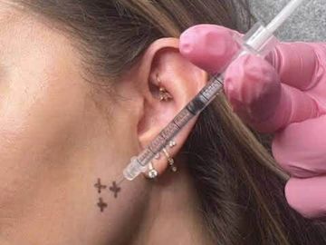 A woman receives a cosmetic injection near small cross tattoos on her cheek.