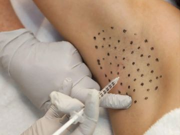Doctor injecting underarm marked with dots for treatment.