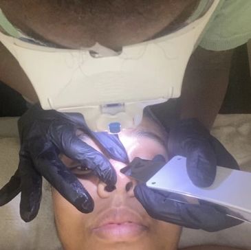 Facial exfoliation with advanced tool