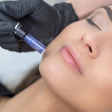 Micro-needling