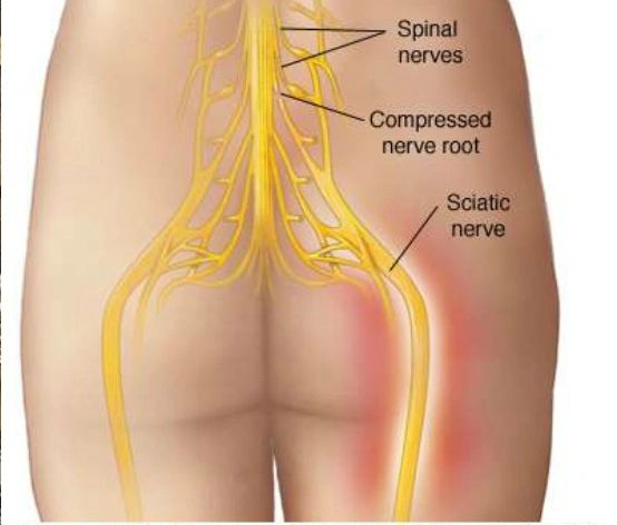 Can Acupuncture Relieve Sciatica Pain?