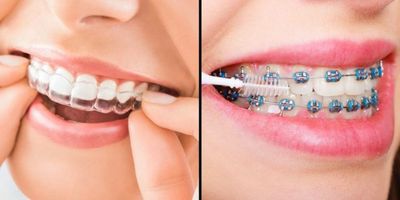 Invisalign, clear aligners