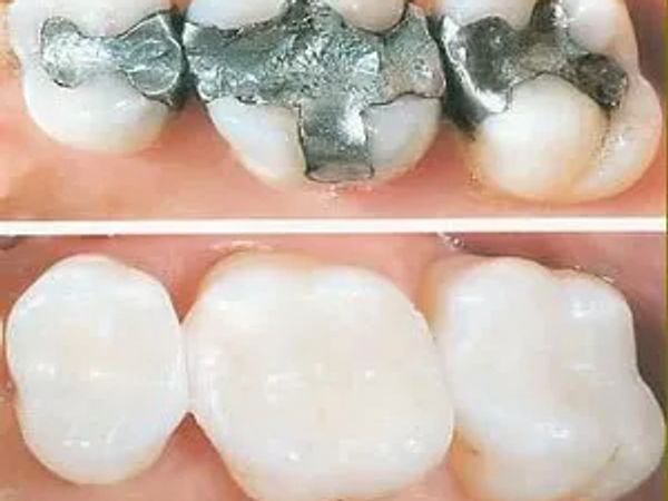 White fillings
