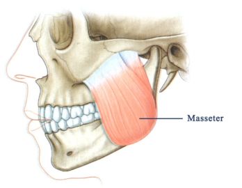 TMJ Injections for Bruxism (teeth grinding) and jaw pain.