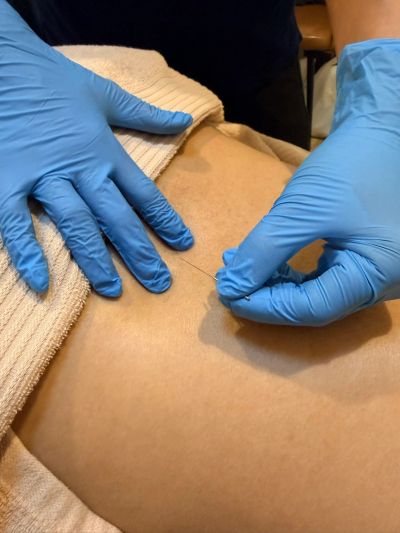 Doctor performing acupuncture on a patient's back.