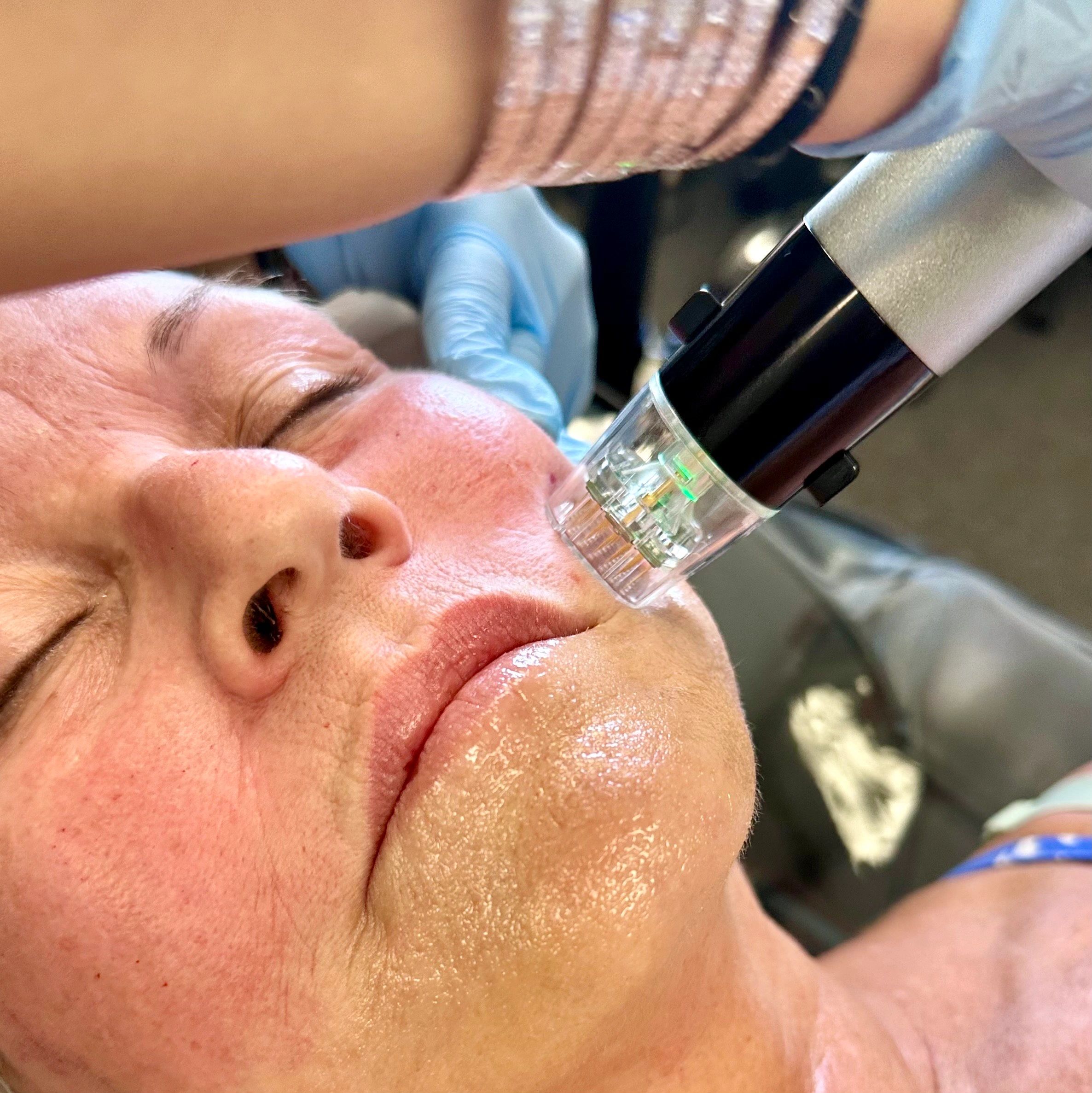 RF Microneedling in Woburn, MA