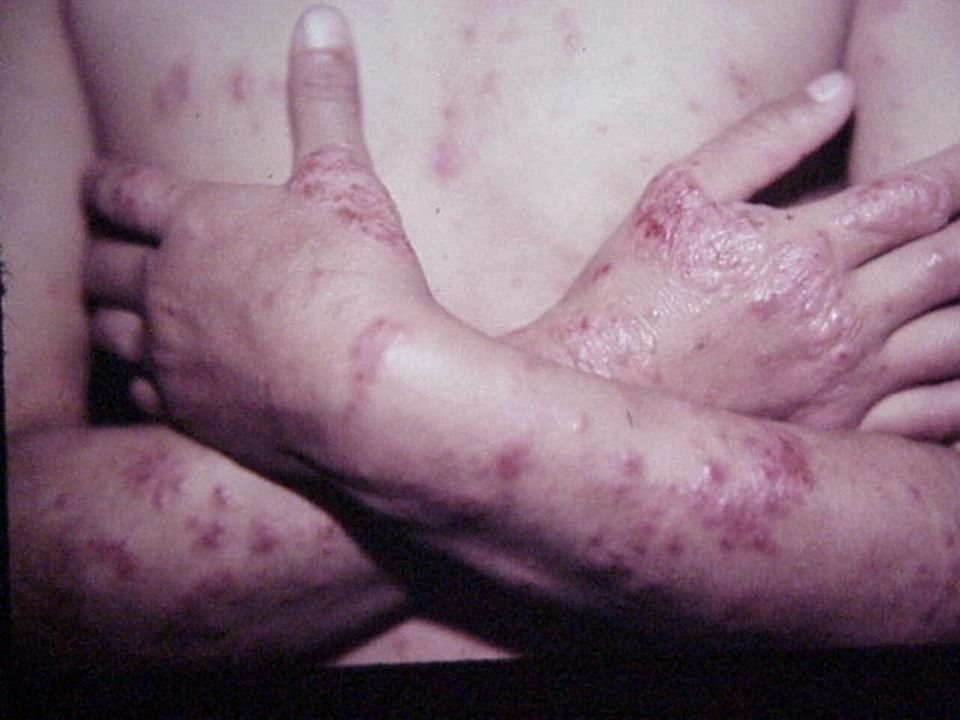 60 Day Exposure Fungal Skin Infection 