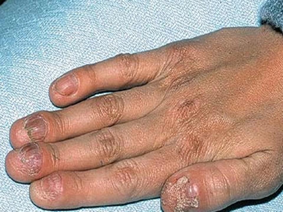 Aspergillosis Mold Infection of the Skeletal System