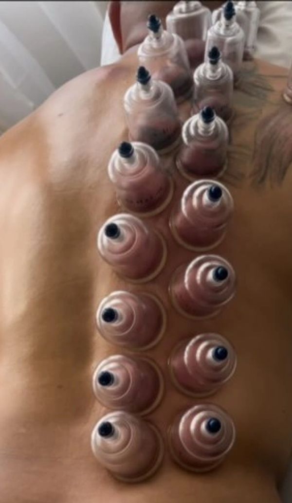 Cupping