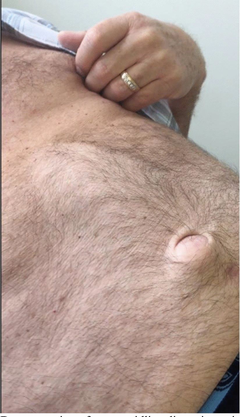 Divarication of Recti: Abdominal Wall Muscle Failure.