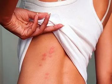 Person showing red, itchy skin rashes on their back.