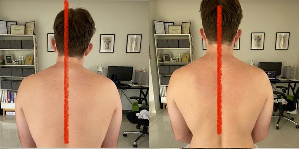 Bowen Therapy For Back Pain – Bowen and Natural Therapies