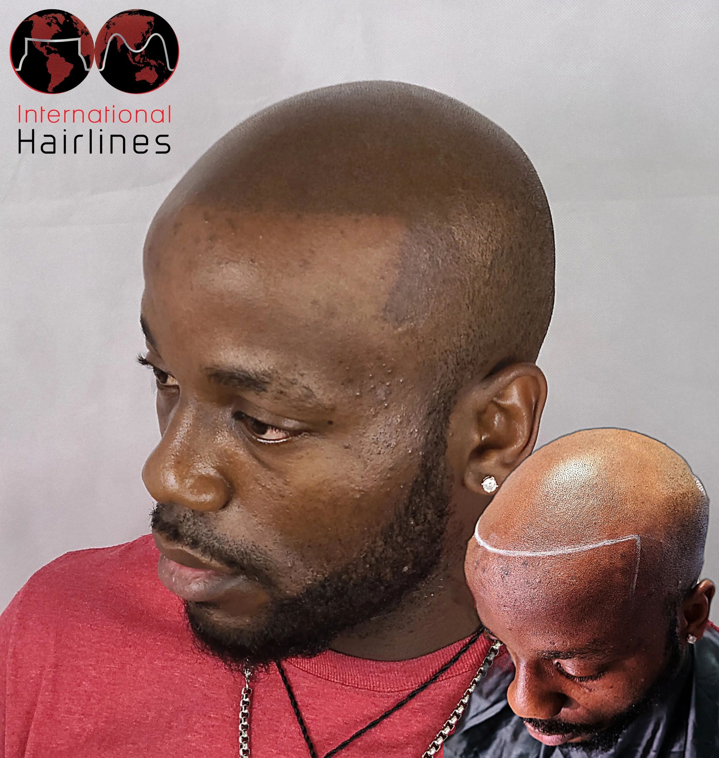 Scalp Micropigmentation SMP for hair loss Palm Bay, Melbourne Beach, Indialantic, Viera, Florida.