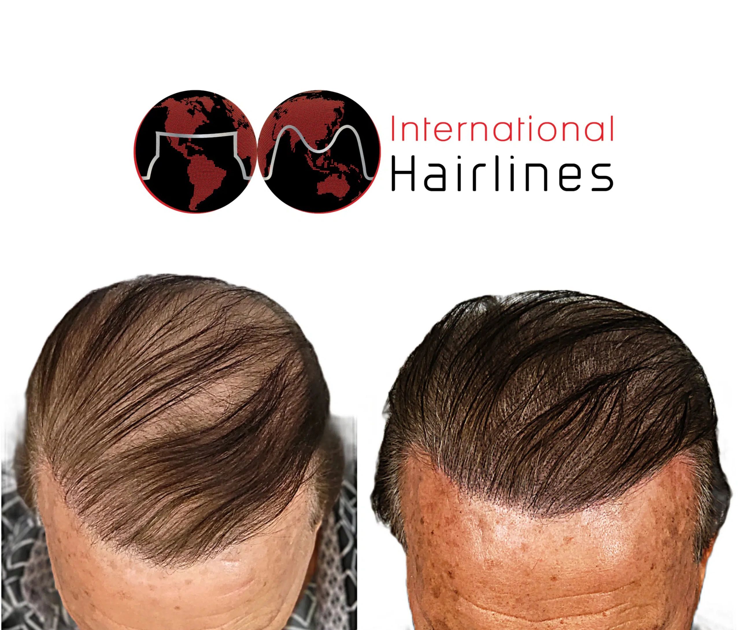 Scalp Micropigmentation SMP for thinning hair in men Palm Bay, Melbourne, Indialantic,  Florida.