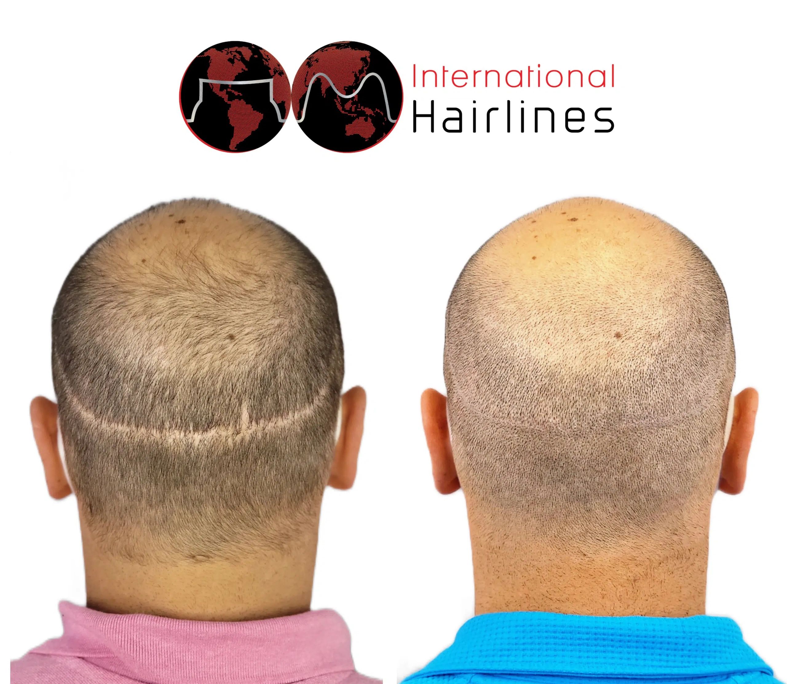 Scalp Micropigmentation SMP for hair transplant scars Melbourne, Indialantic, Viera, Florida.