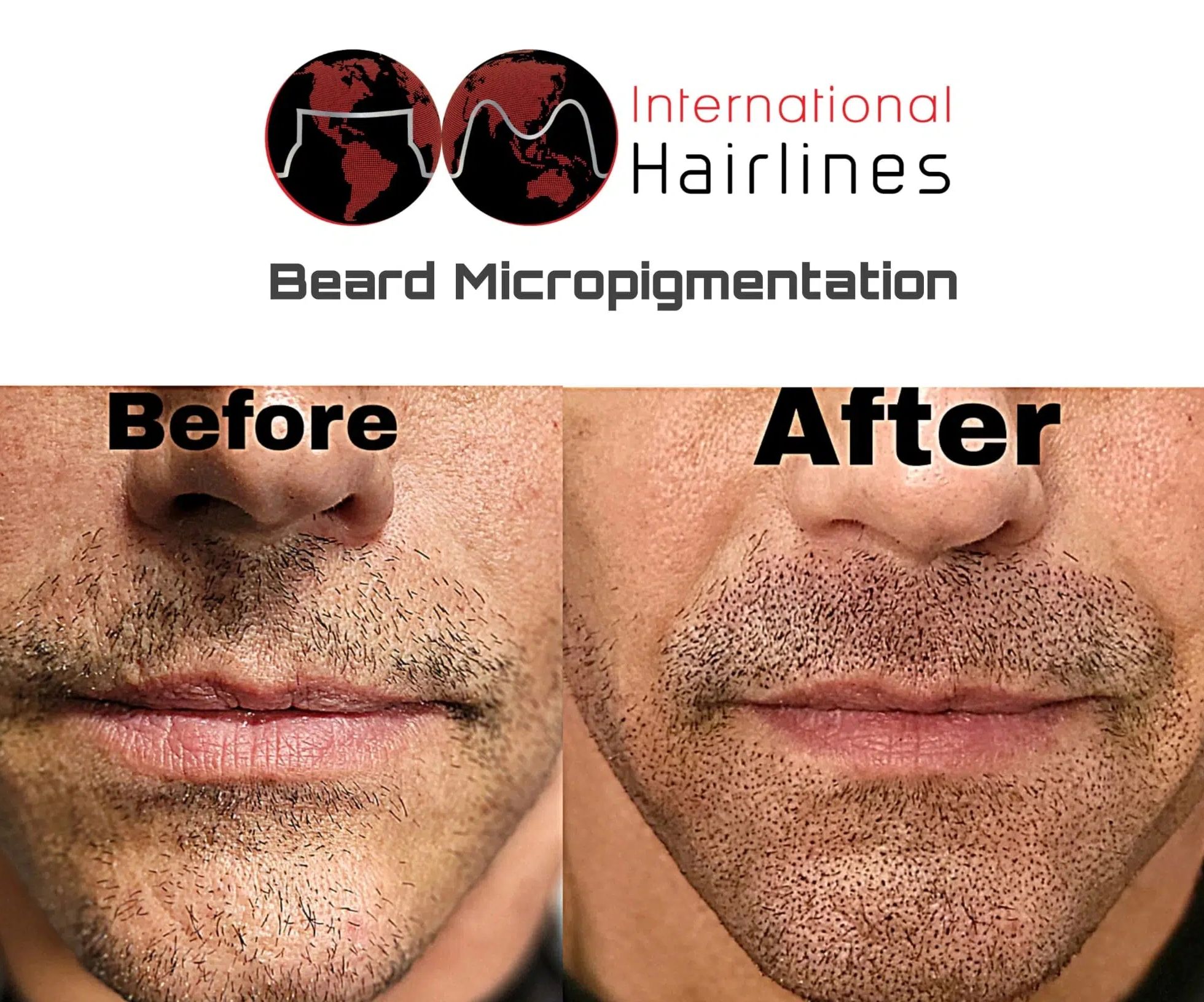 Scalp Micropigmentation SMP for mens beard hair loss Palm Bay, Melbourne, Indialantic, Viera, FLA
