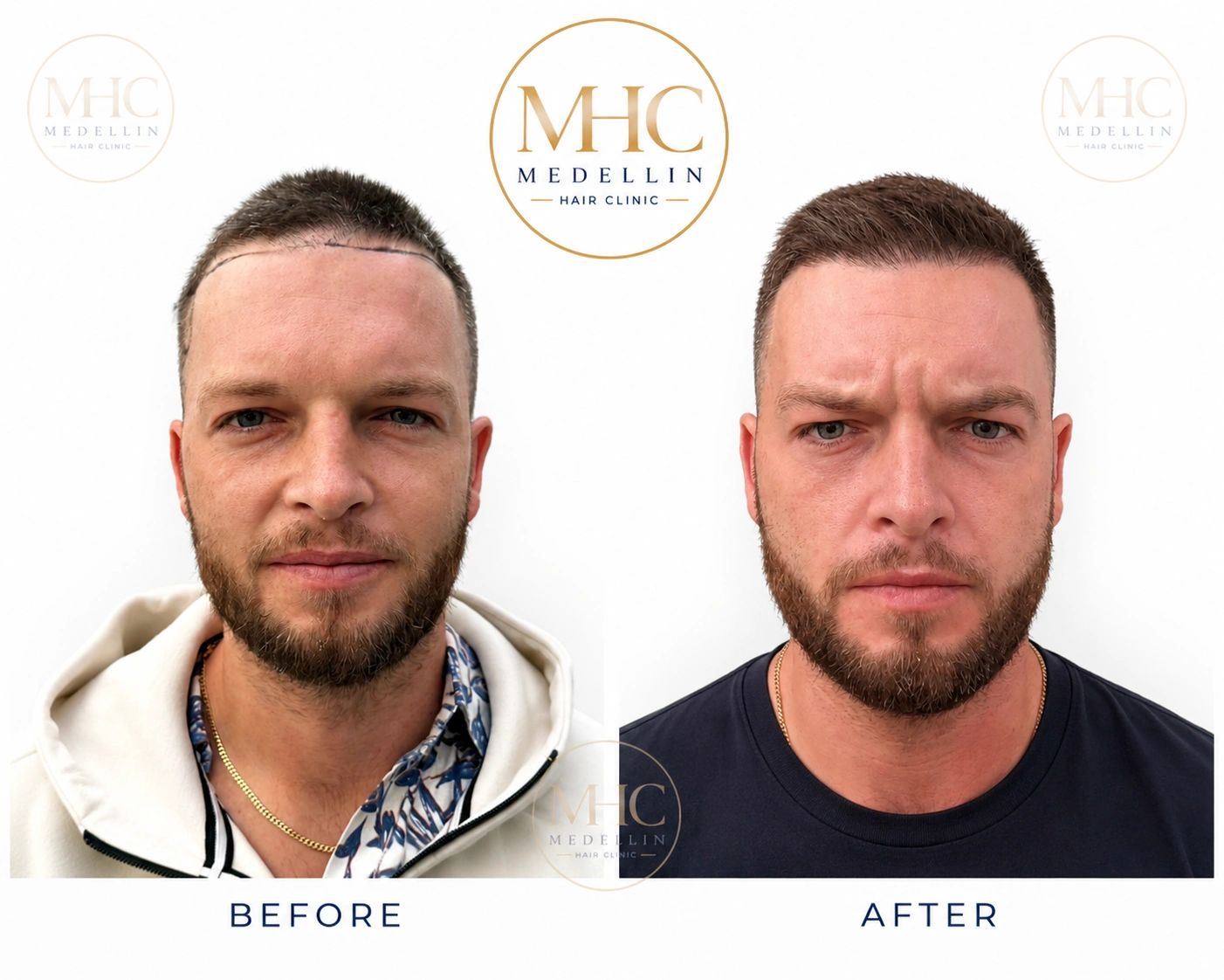 Before and after hair transplant results.
