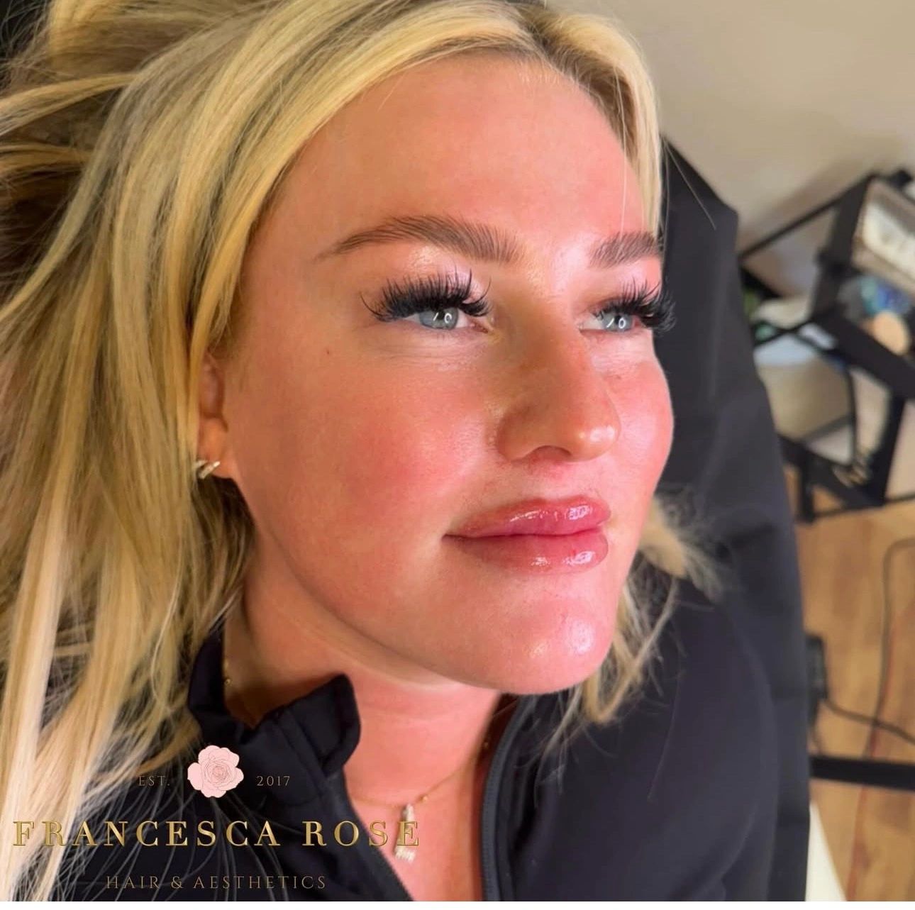Lip filler & Botox client 