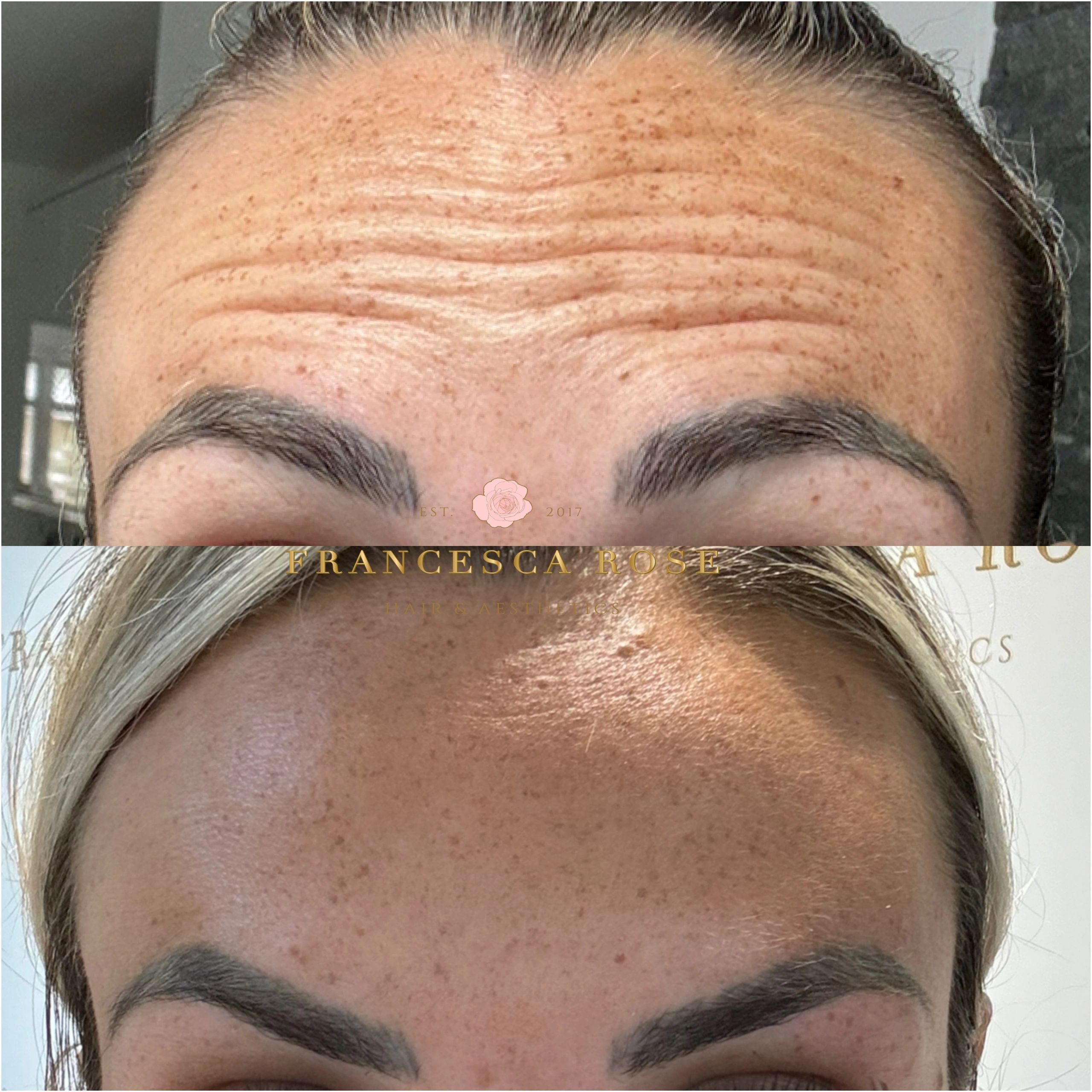 Anti wrinkle injection results
