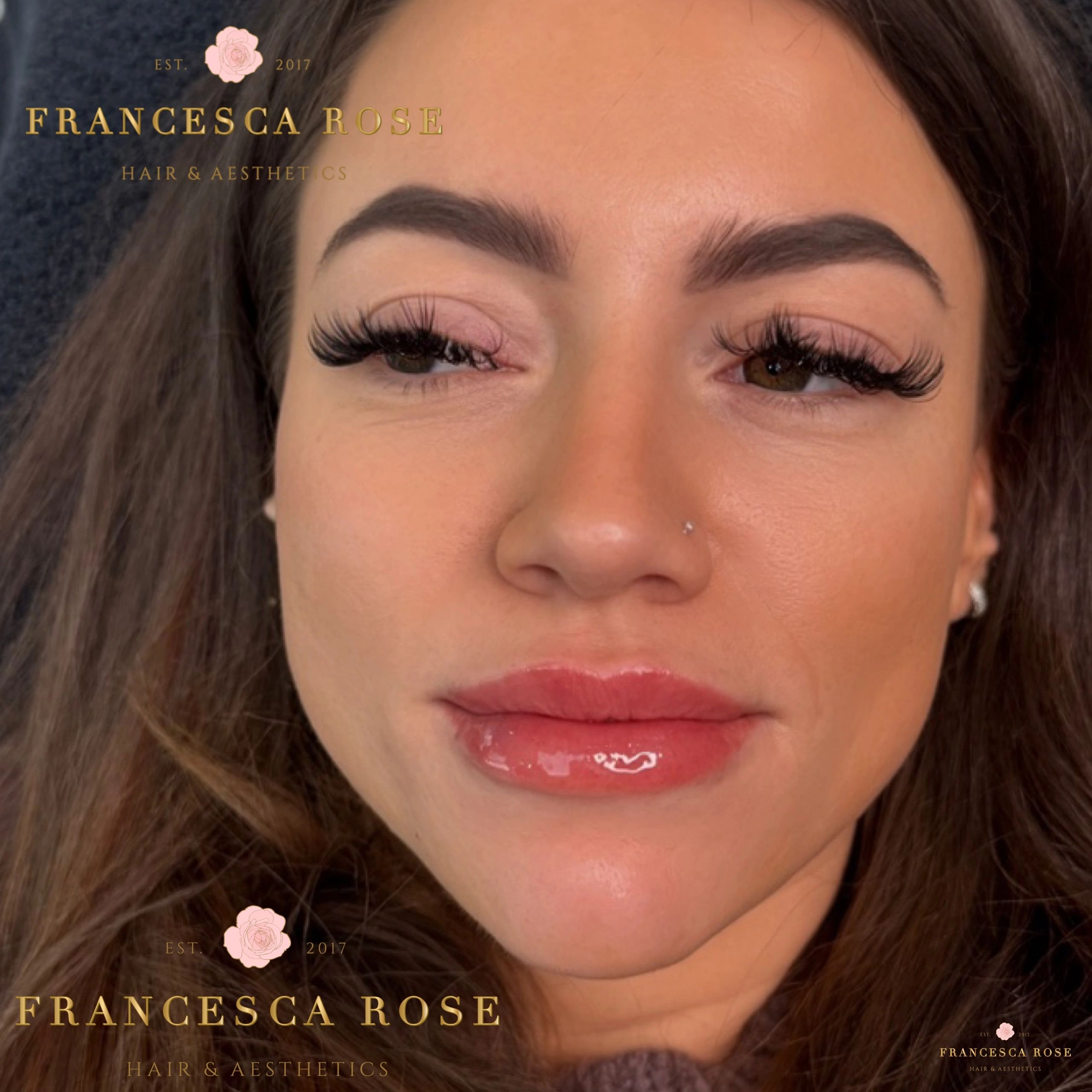 Lip filler enhancement 