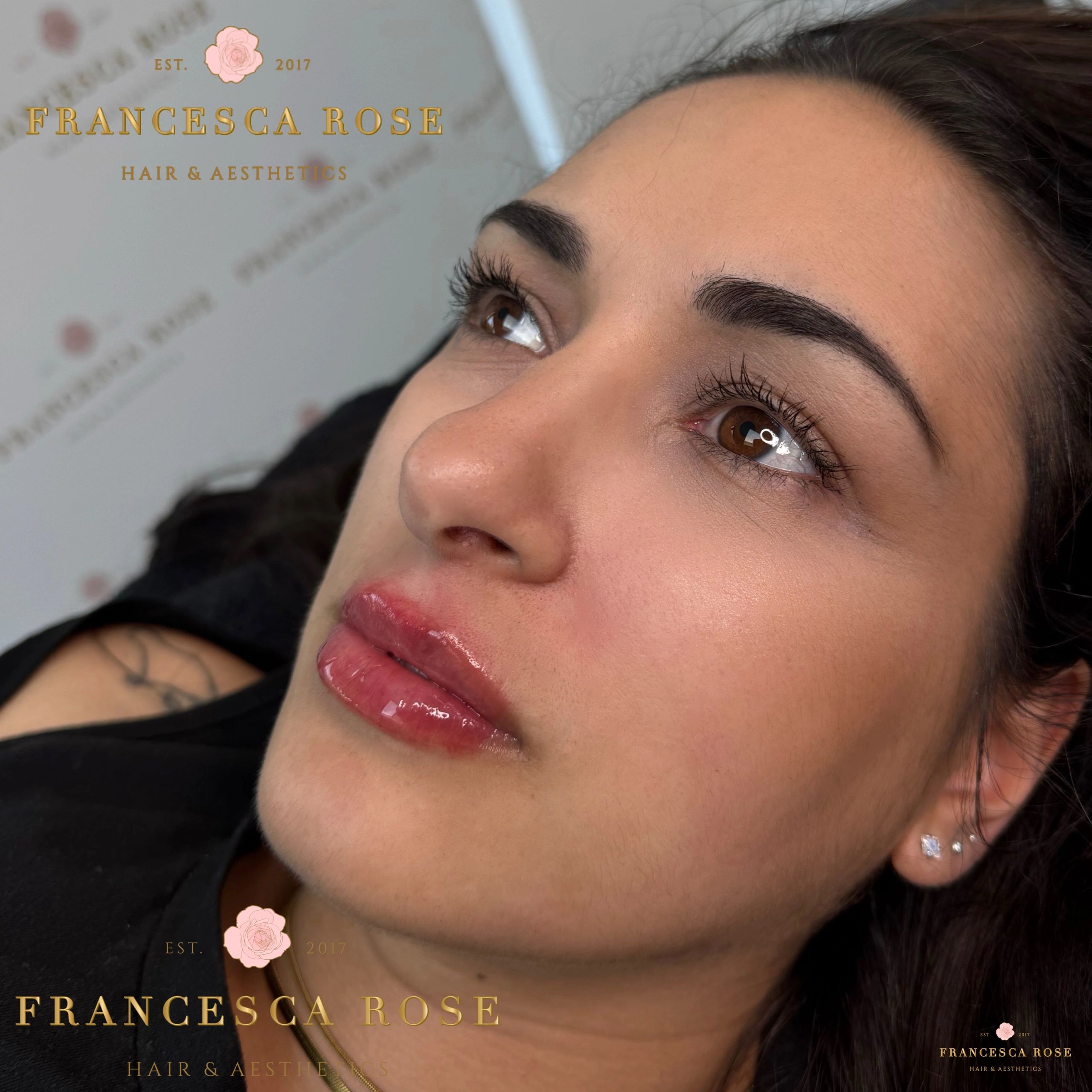 Lip Filler enhancement