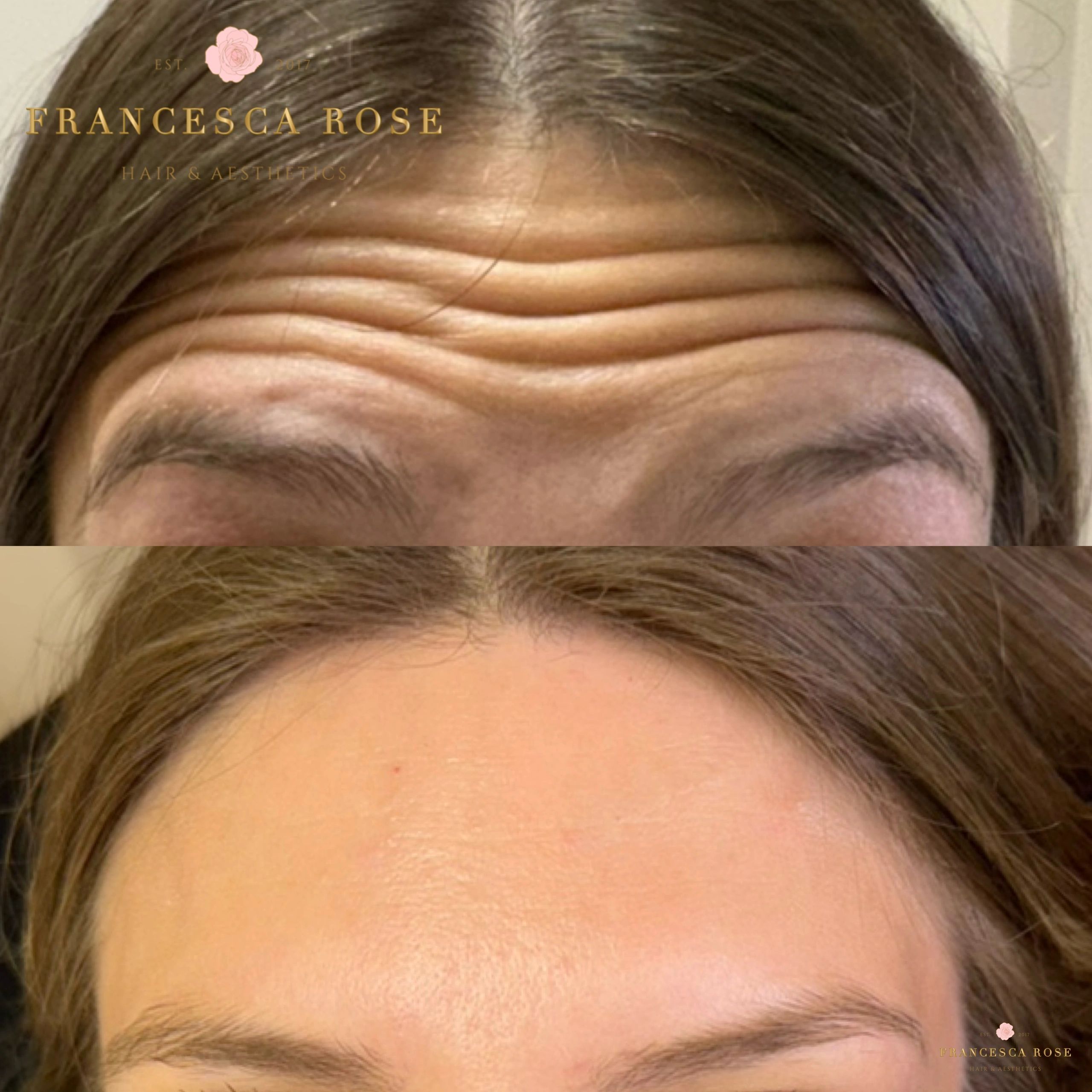 Anti wrinkle injection 