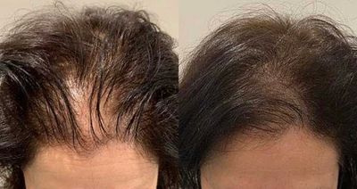 Scalp Micropigmentation with a nano needle technique.
