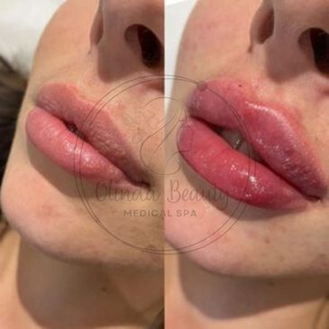 Antes y después de mujer a quien le realizaron Russian lips tehnique.