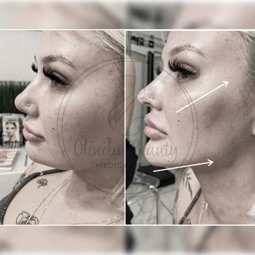 Antes y después de mujer luego de realizarse un Snatch contouring face en Olinda Beauty Medical Spa