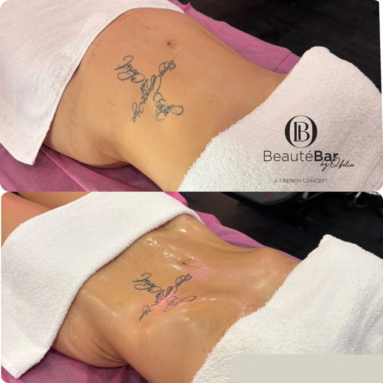 Body contouring treatment showing before and after results.