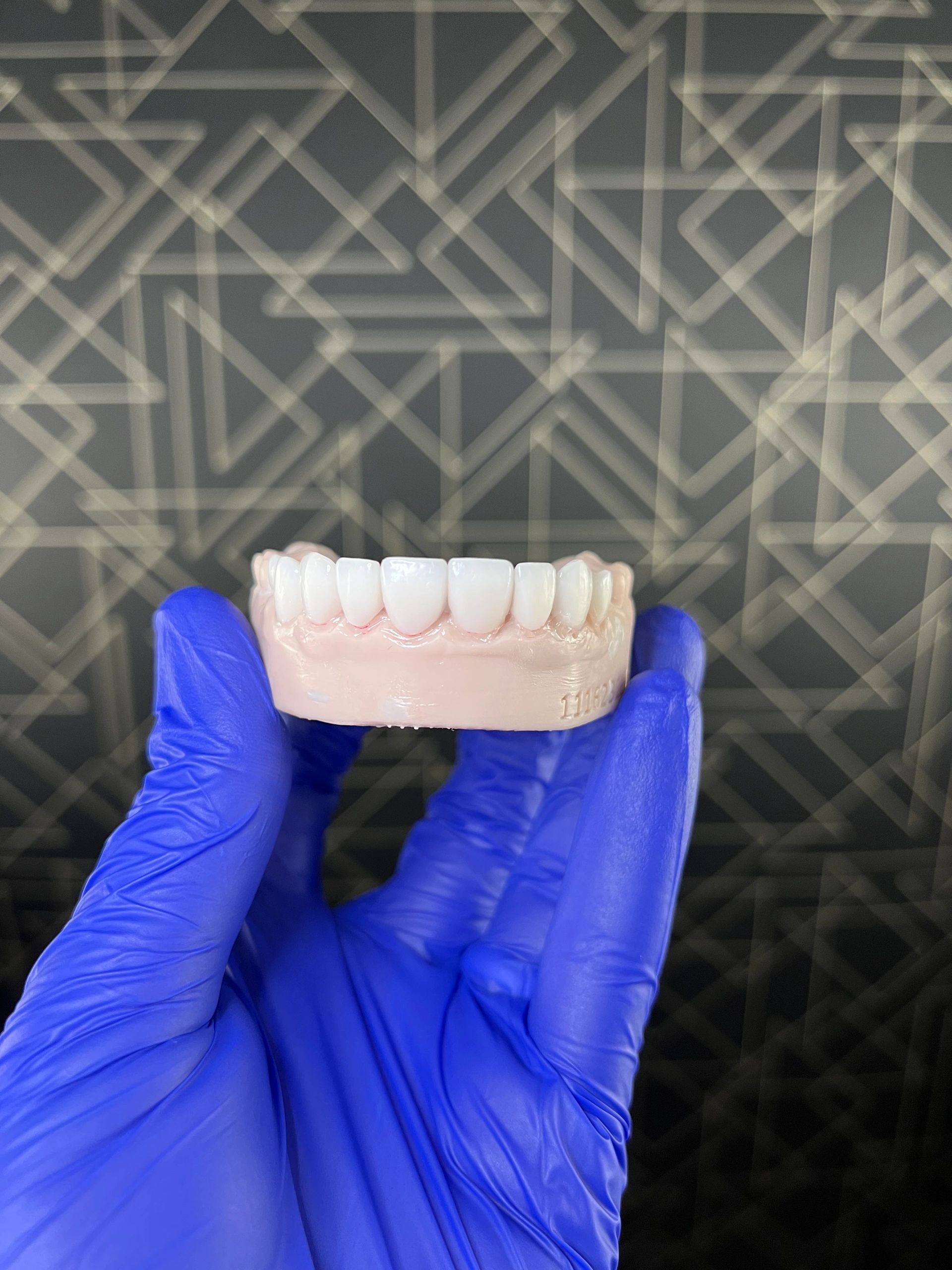 What are Veneers? A short guide veneers in Chicago IL