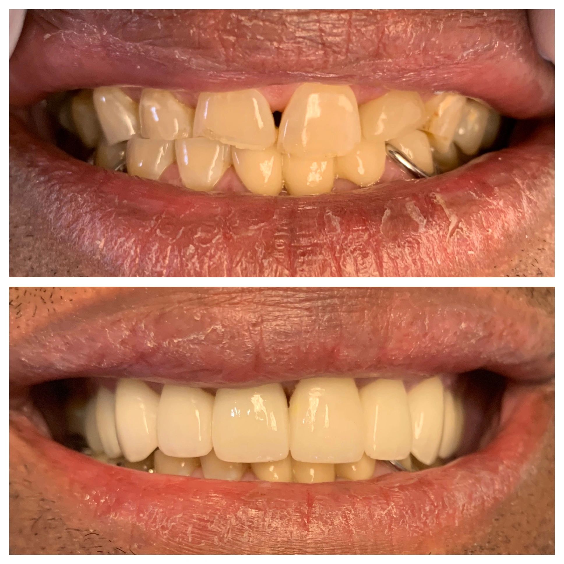 Teeth Repair cracked or worn teet 