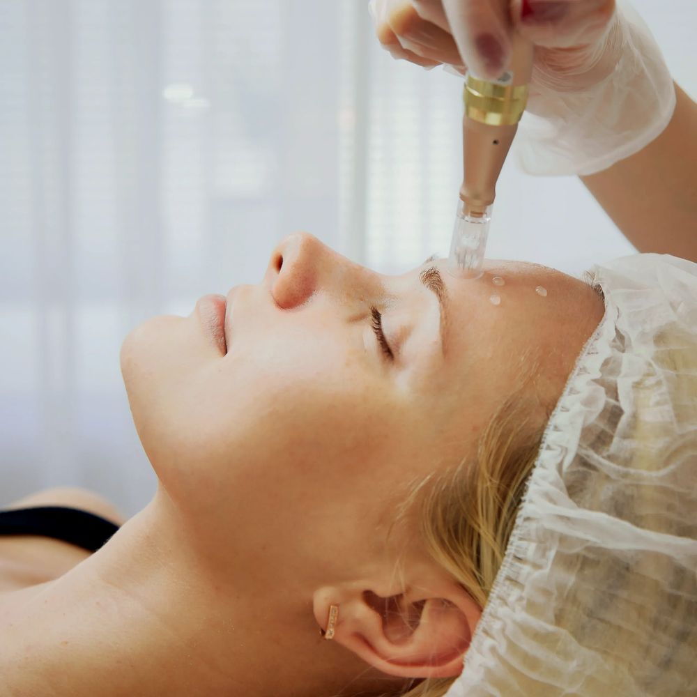 Woman undergoing a microneedling facial treatment with closed eyes.